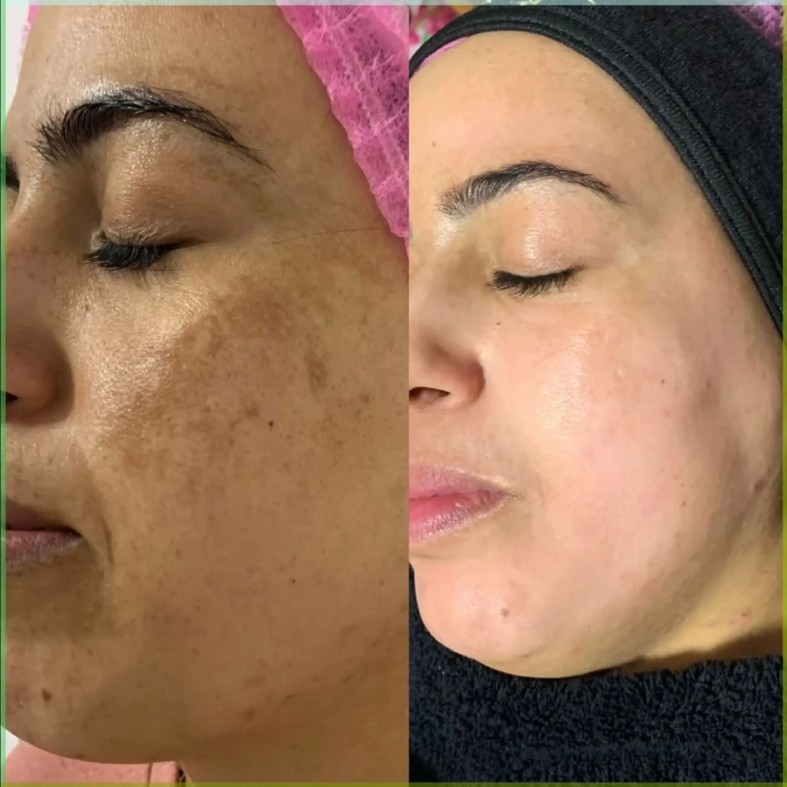 Fractional laser and peeling _20250825_085500_٠٠٠٠-14