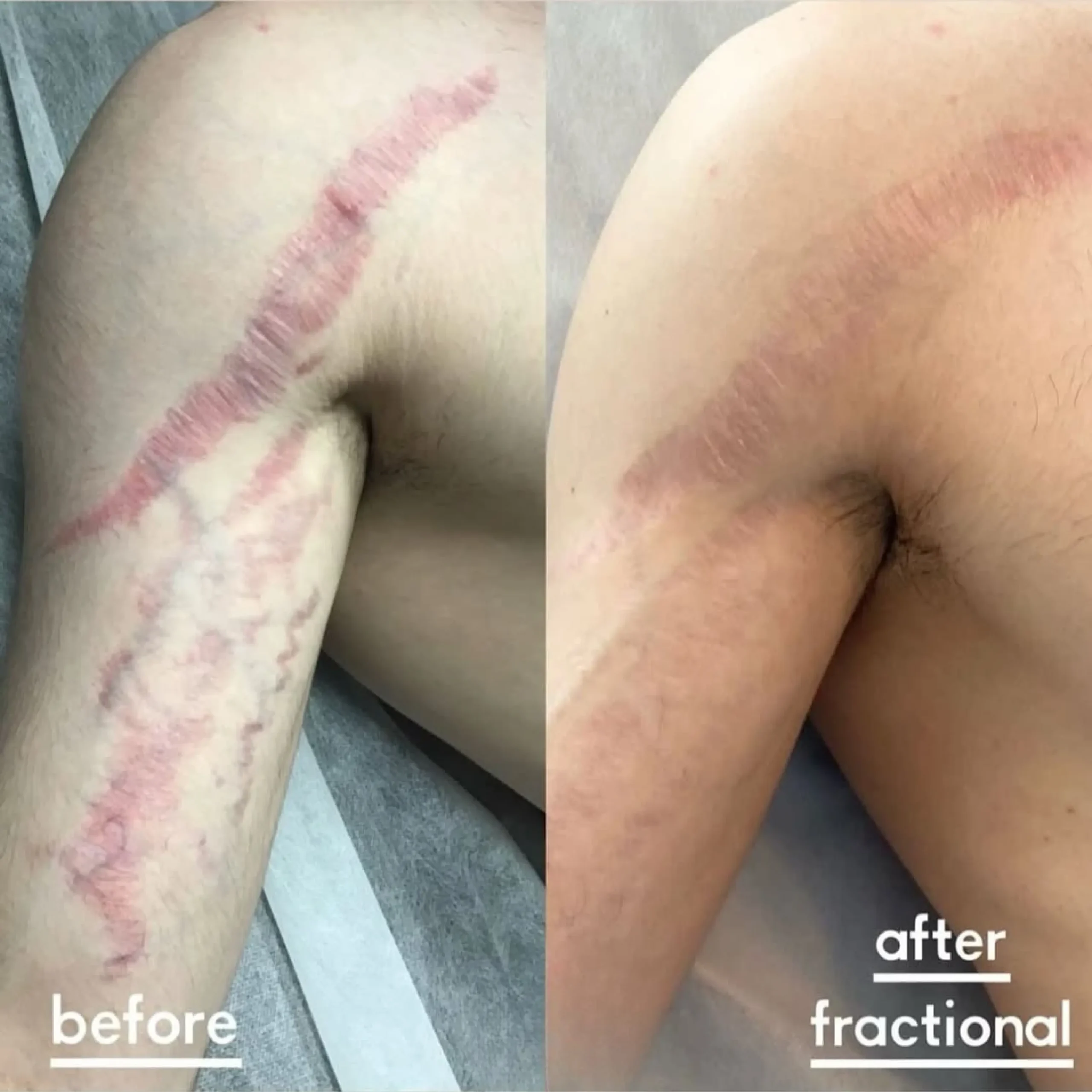 Fractional laser and peeling _20250825_085500_٠٠٠٠-4