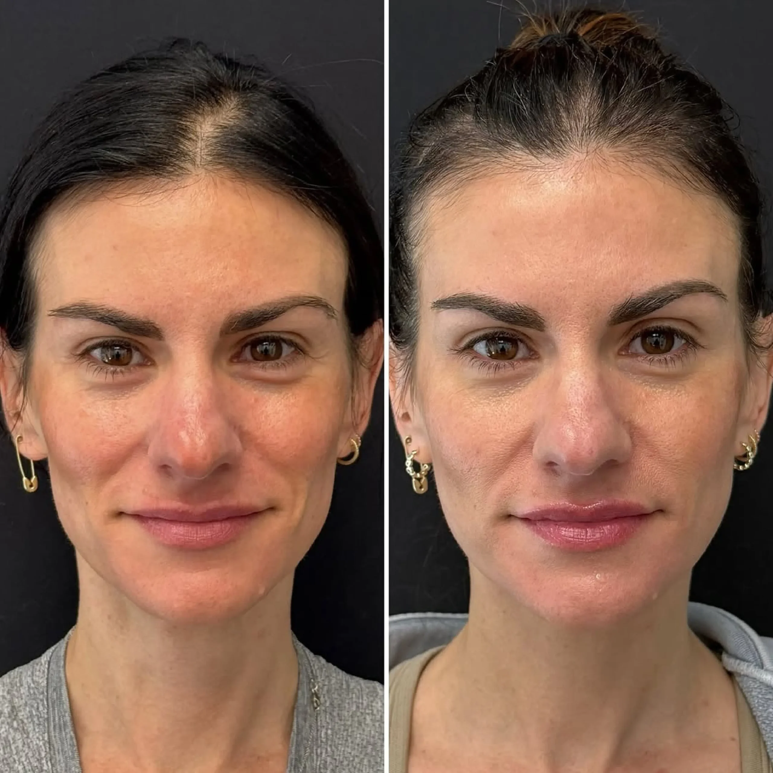 ابر النضارة skin booster _20250825_081841_٠٠٠٠-12